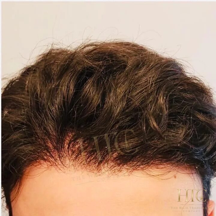 After — Case HT-004. Individual results may vary.