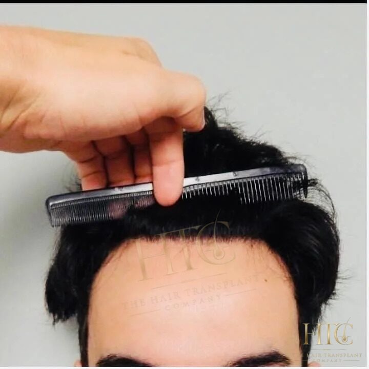 Before — Case HT-004. Individual results may vary.