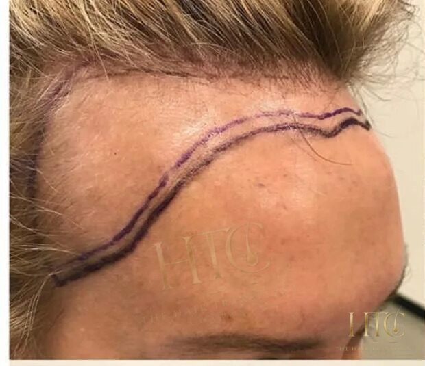 Before — Case HT-006. Individual results may vary.
